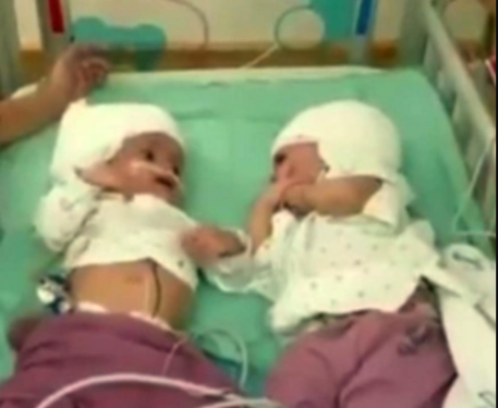 Israele, raro intervento separa due gemelline siamesi