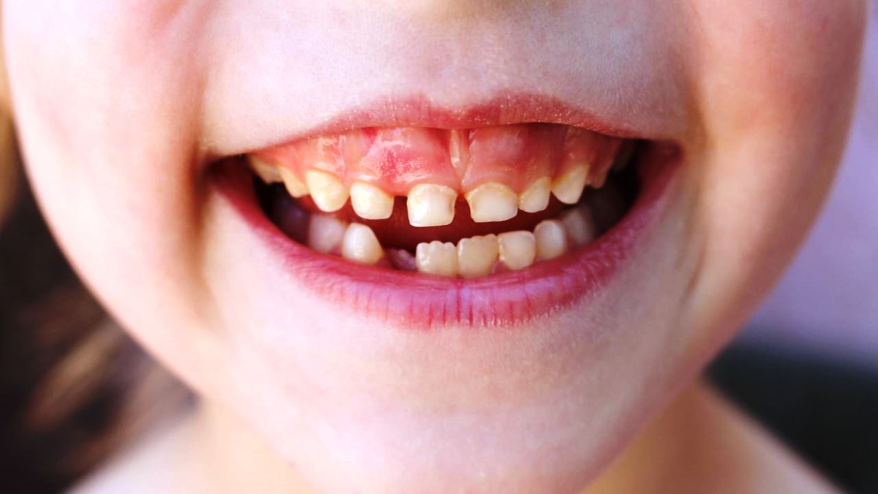 Denti da latte e disturbi mentali: c’è una correlazione? Denti da latte e disturbi mentali: c’è una correlazione?