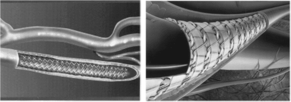 Nitinol: materiale dalle caratteristiche intelligenti particolari Nitinol: materiale dalle caratteristiche intelligenti particolari