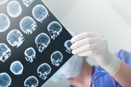 El mayor estudio genómico sobre el alzheimer aclara cómo se origina la enfermedad El mayor estudio genómico sobre el alzheimer aclara cómo se origina la enfermedad