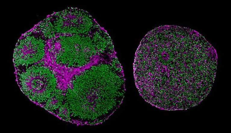 Gene Therapy Reverses Effects of Autism-Linked Mutation in Human Brain Organoids