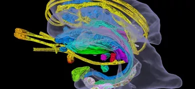 Un approccio innovativo alla diagnosi precoce delle demenze basato sullo studio della connettività funzionale del cervello attraverso metodiche informatiche