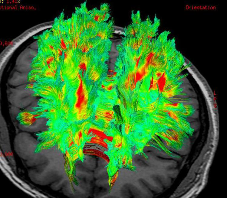 Grasso e cervello si parlano, la scoperta degli scienziati Grasso e cervello si parlano, la scoperta degli scienziati