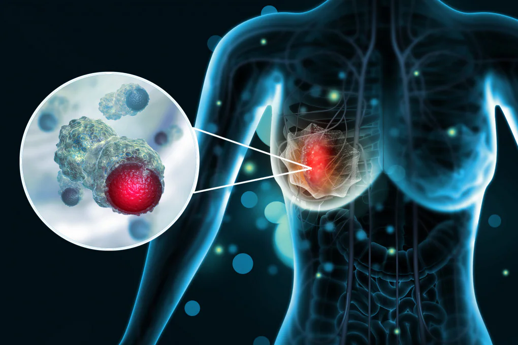 Come funziona il nuovo farmaco contro il tumore alla mammella?