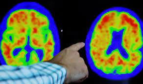 Alzheimer’s diagnosis revamp embraces rating scale similar to cancer